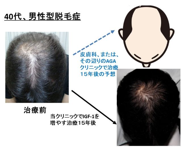 円形脱毛症　病院